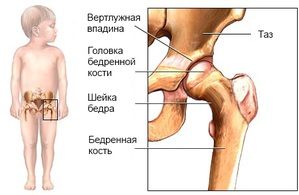 Дисплазия тазобедренного сустава у детей 2