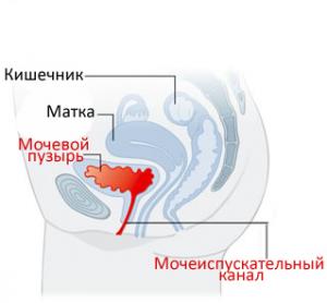 цистит при беременности