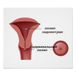 полип эндометрия