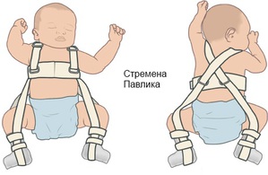 Дисплазия тазобедренного сустава у детей 4