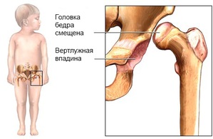 Дисплазия тазобедренного сустава у детей 3